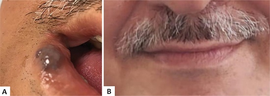 Imagens clínicas: A) Antes do tratamento e B) Após quatro
                        semanas de tratamento com dose única de OE5% 0,2ml
                        intralesional