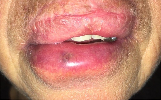 Edema após cinco minutos da infiltração de 0,1ml de
                        OE5%. A paciente referia sensação de peso local e
                        queimação discreta