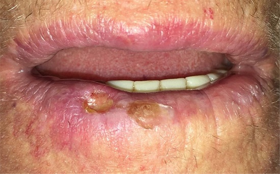 Ulceração e necrose após duas semanas da
                        aplicação superficial depois de infiltração
                        intralesional de OE5% 0,1ml em duas lesões no lábio
                        inferior