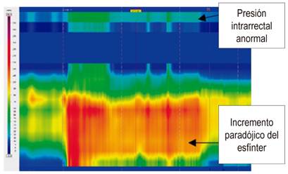 Disinergia defecatoria tipo 2