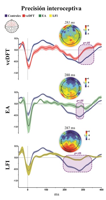 Figura
2. Modulaci&oacute;n del HEP en
la condici&oacute;n de precisi&oacute;n interoceptiva. Comparaci&oacute;n del HEP
punto por punto entre los grupos de pacientes y sujetos del grupo control a
trav&eacute;s de la prueba de permutaci&oacute;n de Monte Carlo. Los cuadros violetas indican
p < .05 (se seleccion&oacute; una extensi&oacute;n
m&iacute;nima de cinco puntos consecutivos como criterio para graficar los cl&uacute;steres. Las
barras ensombrecidas alrededor de los potenciales indican el SEM. La topograf&iacute;a
de cuero cabelludo muestra las diferencias en amplitud (microvolts)
entre cada grupo de pacientes y controles. Los puntos rojos en el diagrama de
localizaci&oacute;n de canales ilustran los electrodos incluidos en la regi&oacute;n de inter&eacute;s
fronto-central.