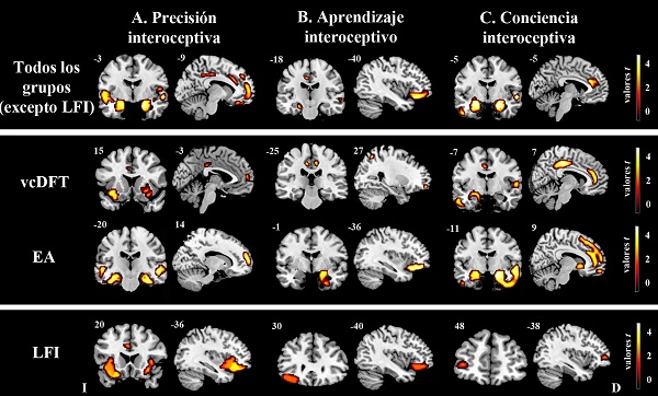 Figura 3. Asociaci&oacute;n estructural con las dimensiones interoceptivas. Se realiz&oacute; un an&aacute;lisis de regresi&oacute;n que consider&oacute; a
los pacientes con vcDFT-EA-control para explorar las
asociaciones entre el desempe&ntilde;o en la tarea de detecci&oacute;n de latidos card&iacute;acos con
el volumen de materia gris (an&aacute;lisis de cerebro completo &ndash;panel superior). Se
realizaron regresiones que consideraron a los pares: control-vcDFT y control-EA para identificar regiones interoceptivas
espec&iacute;ficas para cada grupo de pacientes (panel central) (todos ps < .001, umbral
de extensi&oacute;n = 50 v&oacute;xeles). Para los pacientes con LFI, se realizaron
correlaciones de Spearman entre el desempe&ntilde;o en las tareas y las m&aacute;scaras de sustancia
gris (p < .05, fondo). I
= izquierda; D= derecha. 

 