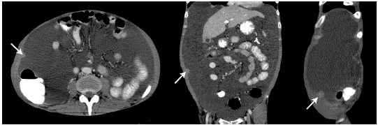 PERITONEAL HISTOPLASMOSIS. CASE REPORT